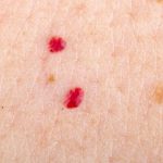 ruby spots huidaandoening rood huid